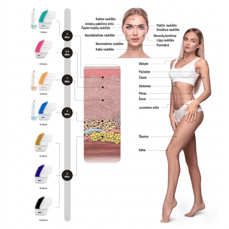 ultraformet mpt treatment zones v2 HIFU procedūra su ULTRAFORMER MPT